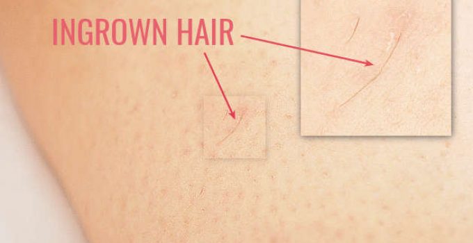 How To Prevent Ingrown Hairs When Epilating, Shaving or Waxing
