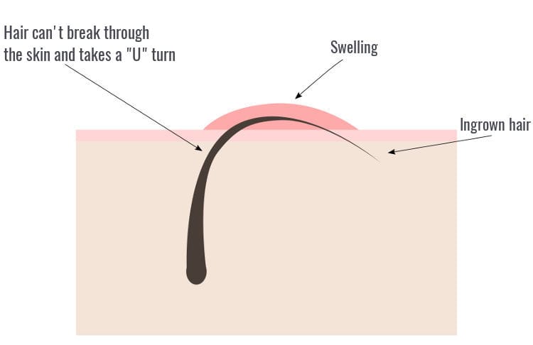 how ingrown hairs appear