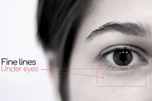 How To Get Rid Of Fine Lines Under Eyes: Preventing Eye Wrinkles