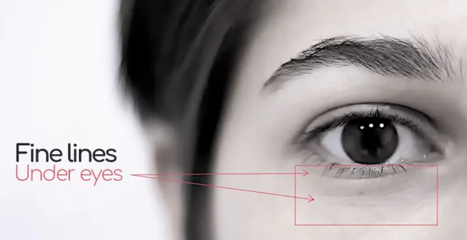 How To Get Rid Of Fine Lines and Wrinkles Under Eyes
