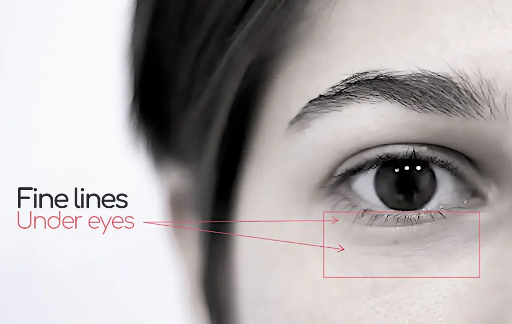 how to get rid of fine lines under eyes