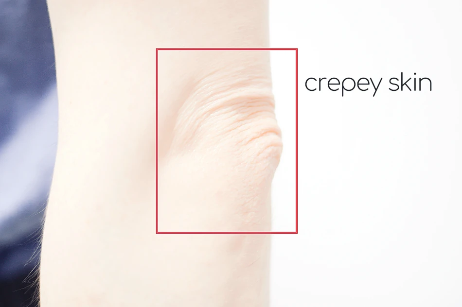 crepey skin